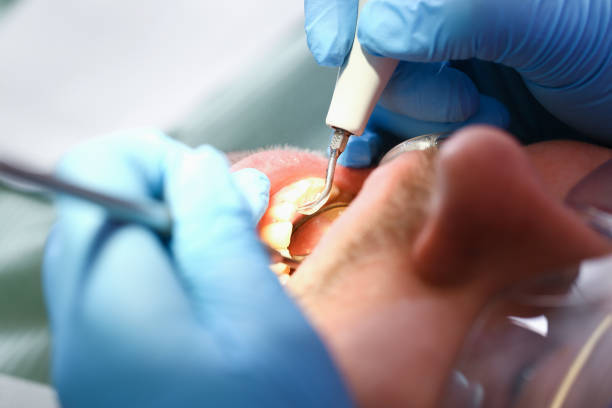 Best Emergency Root Canal Treatment in Chelsea, MI
