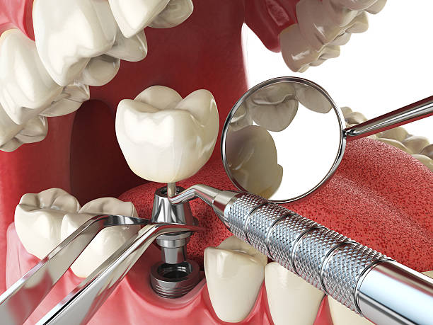 Best Emergency Dental Care for Broken or Chipped Teeth in Chelsea, MI